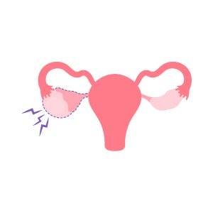 causes de l'ovulation douloureuse